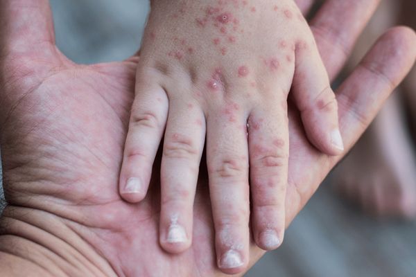 الكونجو تعلن عن انتهاء تفشّي جدري القرود بعد استمراره عامين