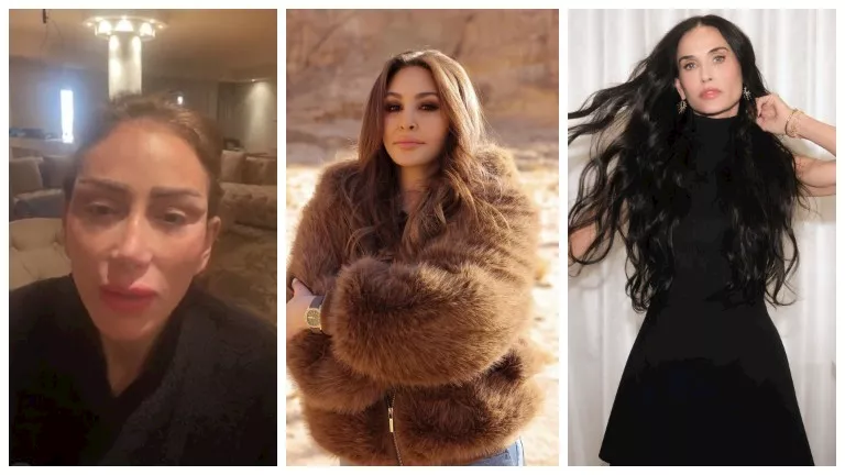 منة عرفة ليست الأولى.. . نجمات عانوا من تشوهات بسبب التجميل