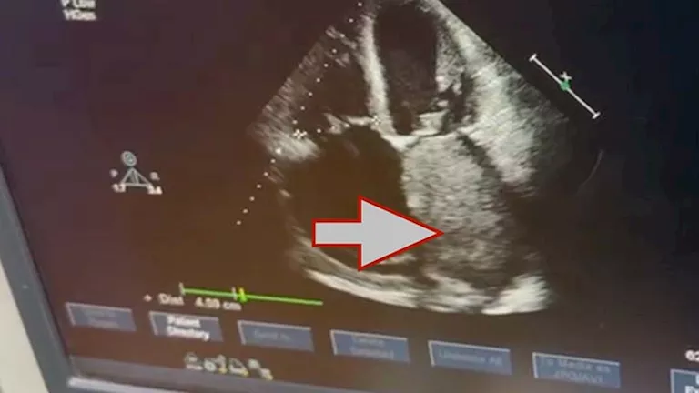 جراحة قلب معقدة لاستئصال ورم ضخم بالقلب لمريض بقصر العيني