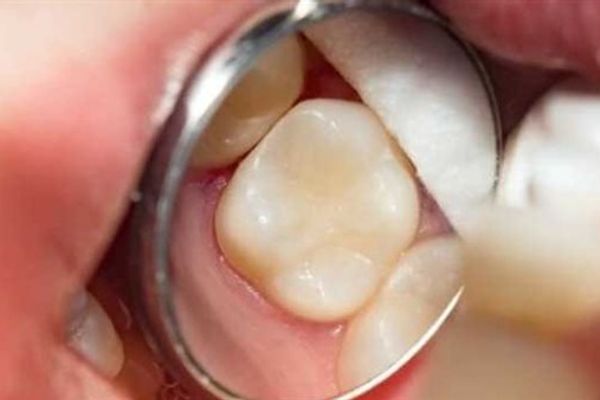 المخاطر الخفية لتآكل الأسنان التدريجي