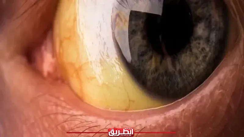اصفرار العين عرض ولا مرض ؟