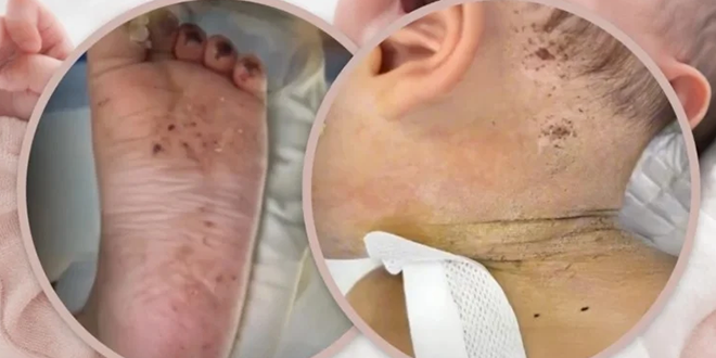 ظنت أنها تعالجه.. أم توخز رضيعها بالإبر 600 مرة