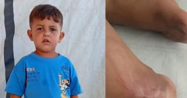 بيحلم يمشي تانى.. يزن علوان يخوض معركة مع الألم فى انتظار العلاج خارج غزة