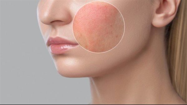 وصفة طبيعية لتهدئة البشرة الملتهبة بعد إزالة الشعر