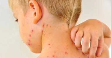 «فاكسيرا» تحذر من مضاعفات الجديري المائي للأطفال وتشدد على ضرورة التطعيم