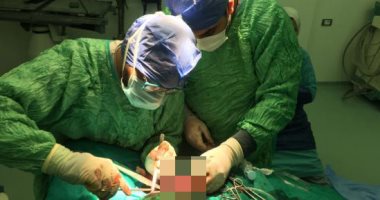إجراء جراحة عاجلة لرضيع عمره 8 أيام مصاب بثقب فى المعدة بمستشفى طنطا العام