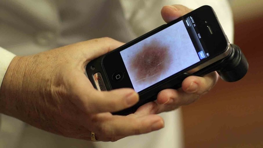 تطبيق ذكاء اصطناعي يحول الهاتف الذكي إلى أداة لاكتشاف سرطان الجلد