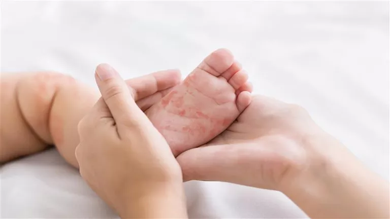 الأعراض الأولية للحصبة ومتى يزداد خطر الإصابة بها