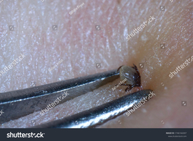 لدغات القراد تسجّل أعلى معدل لزيارات أقسام الطوارئ منذ نحو عقد في أمريكا