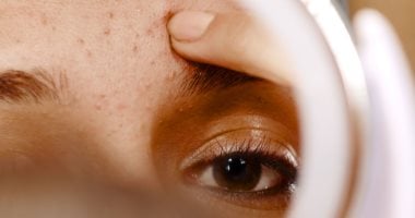 متى تصبح البثور أكثر من مجرد حب شباب؟.. علامات تحذيرية انتبه إليها