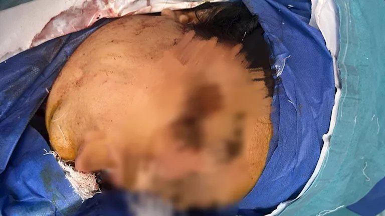 "سكينة في الجمجمة".. تفاصيل تعرض فتاة للطعن على يد خطيبها بالمعصرة