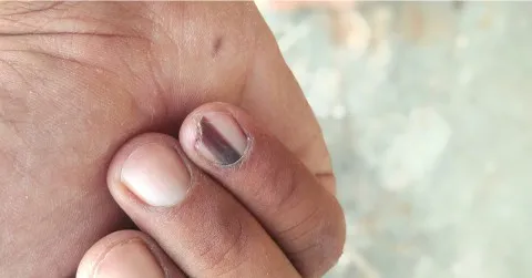 خط أسود في الأظافر.. إشارة بسيطة أم مؤشر صحي مهم؟