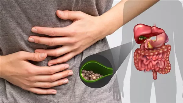 علاقة الكوليسترول بحصوات المرارة؟ استشاري يجيب