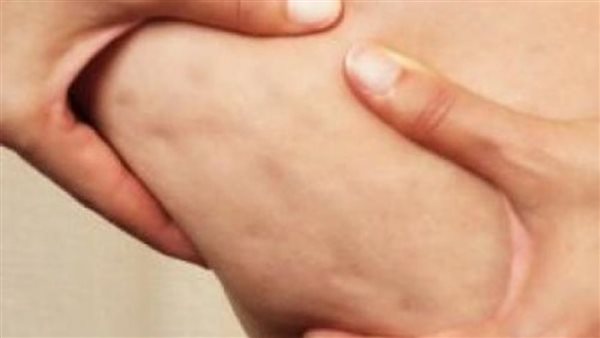 استخدميها بانتظام، أقوى وصفات طبيعية لتقليل السيلوليت