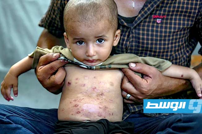 الأمم المتحدة تحذر من تفشي الأمراض الجلدية في غزة وتدعو لتوفير مستلزمات النظافة