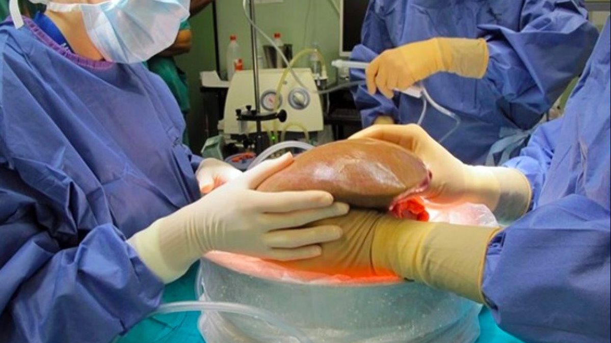 نموذج عملي لتوظيف التكنولوجيا.. الصحة: نجاح زراعة الكبد بتقنيات الطب عن بُعد