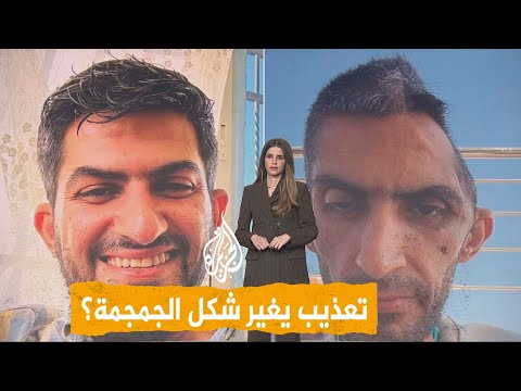 شبكات | صورة مرعبة لجمجمة صحفي فلسطيني بعد خروجه من السجن