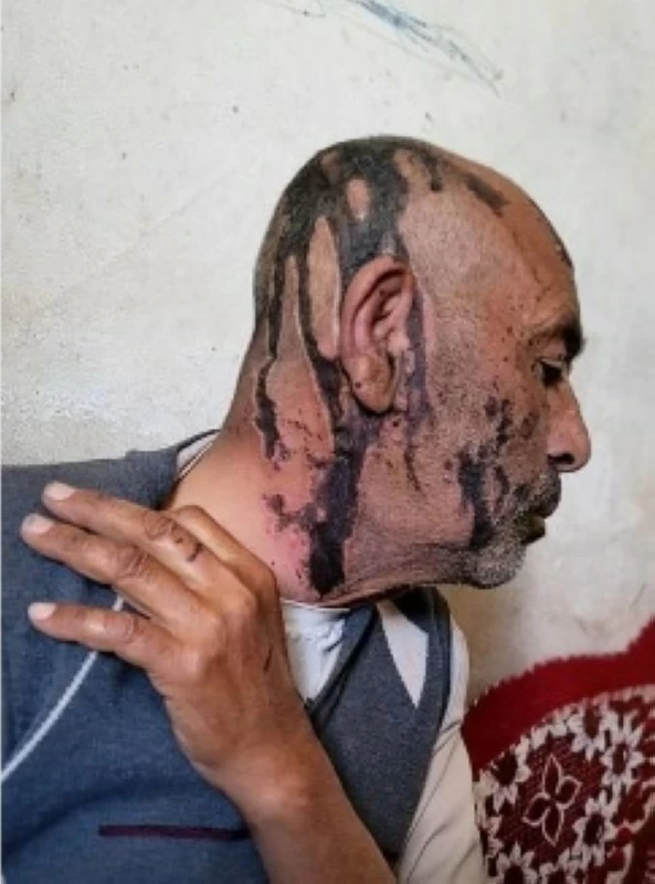مسلحان حوثيان يحرقان والدهما بـ«الأسيد»
