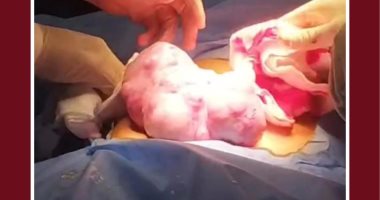 نجاح استئصال ورم خبيث يزن 2 كجم من طفلة عمرها 10 سنوات فى جامعة طنطا