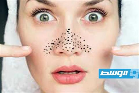 وصفة سحرية من مطبخك للتخلص من بثور الأنف بسهولة وأمان