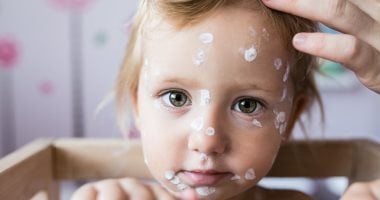 FDA توافق على دواء جديد لعلاج الطفح الجلدى لدى الأطفال