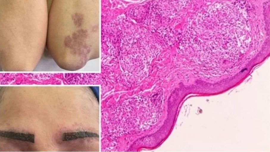 صيحة تجميل شائعة تُصيب امرأة بمرض نادر ينتشر في جسدها بالكامل