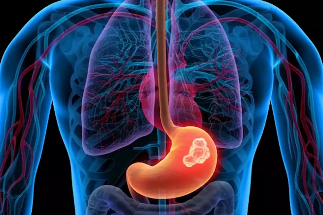 ليست الوراثة.. السبب الأخطر لسرطان المعدة