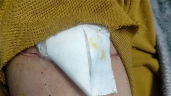 أصابوا زميلتهم بسلاح أبيض، فصل طالبتين لمدة عام وإحالة إدارة المدرسة للتحقيق بالإسكندرية