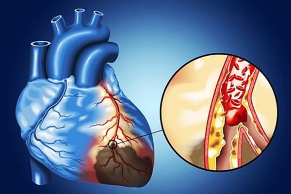 نتائج صادمة حول تأثير الحي السكني على الشرايين والقلب