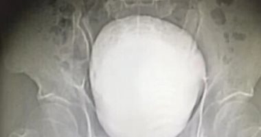 جراحة نادرة تنهى معاناة مزارع صينى مع حصوة ضخمة فى المثانة
