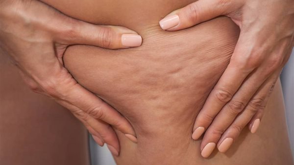 أخصائي سمنة وعلاج طبيعي يكشف أسباب ظهور السيلوليت بالجسم وطرق علاجه