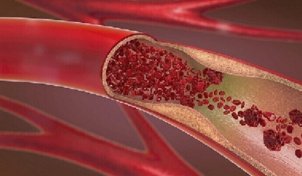 خطر مُميت للجلطات الدموية