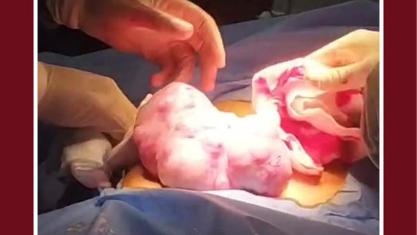 رئيس جامعة طنطا يعلن نجاح فريق طبي في استئصال ورم خبيث يزن 2 كجم من طفلة 10 سنوات