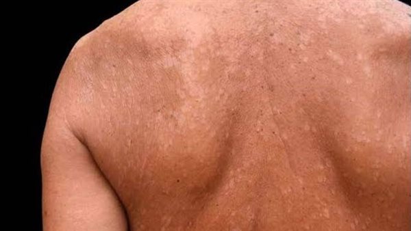 أسباب وأعراض التينيا وطرق علاجها