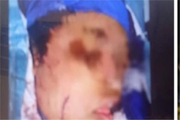 إصابة فتاة في المعصرة بطعنات خطيرة على يد خطيبها والنيابة تحقق