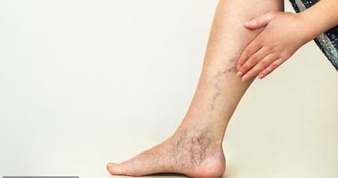 الجلوس لفترات طويلة أيضا قد يسبب دوالى الساقين