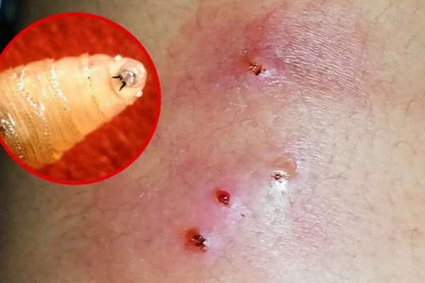 رصدُ دودة آكلة اللحم الحي للمرة الثانية في ولاية تكساس الأمريكية