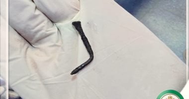 فريق طبى بمستشفى أبو كبير بالشرقية ينقذ طفل ابتلع مسمارا طوله 5 سم