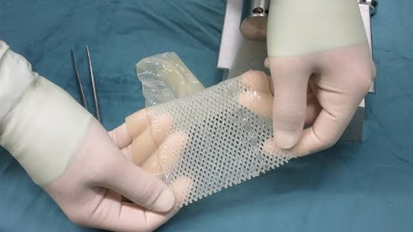 أستاذ جلدية: نقل الجلد بين البشر دون توافق مناعي مستحيل طبيا