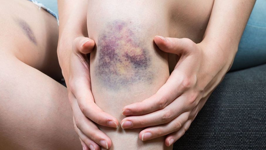 جراح أوعية يوضح الفوارق الجوهرية بين الدوالي والجلطات الدموية