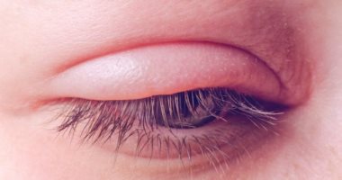 أسباب تورم العين بسبب الحساسية.. اعرف طرق العلاج الفعاله