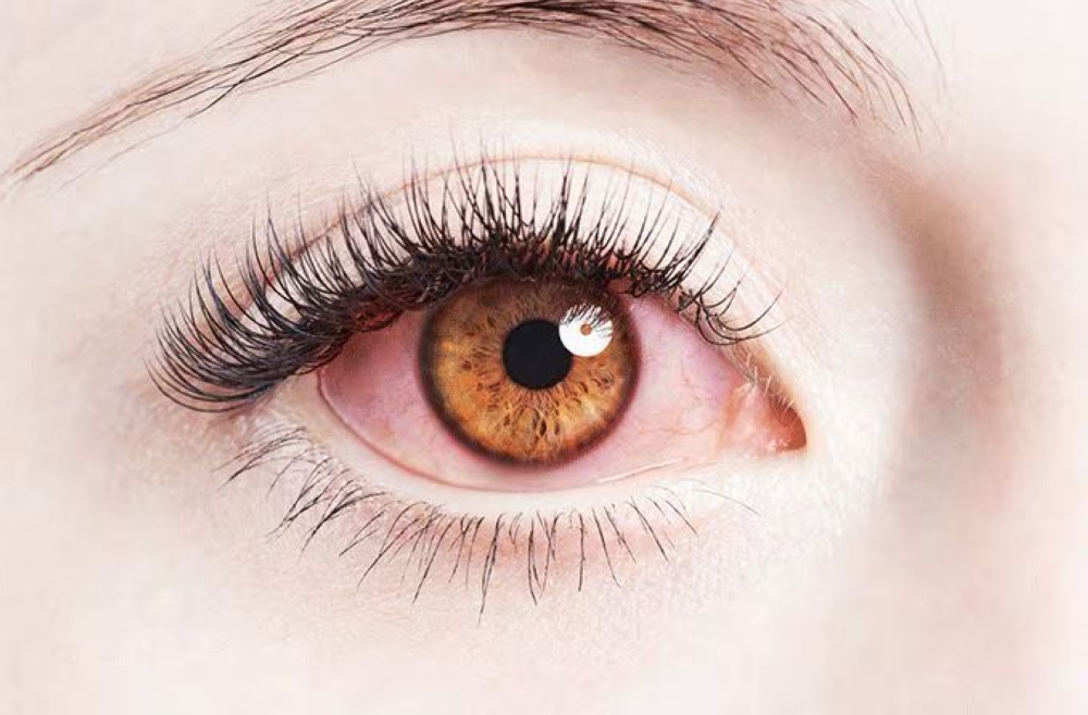 اختصاصي عيون لـ «اليوم» يحذر: المكياج والعدسات التجميلية قد تقود لمضاعفات خطيرة