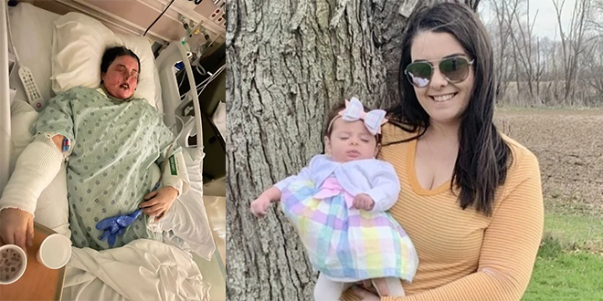 خسرت جلدها وعينيها.. دواء شائع يحرق جسد امرأة ويصيبها بالعمى