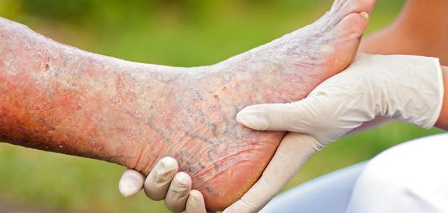 بالأعشاب والخل.. إليك طرق طبيعية لعلاج دوالي القدمين