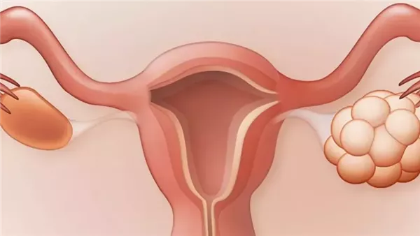 ما الفرق بين تكيسات المبايض والأكياس على المبيض ؟ استشارى يوضح