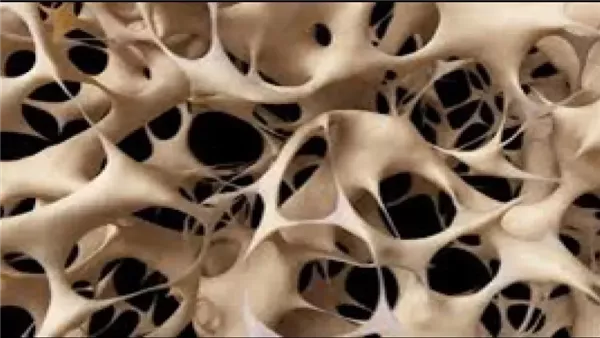 نصائح مهمة تساعد على علاج هشاشة العظام