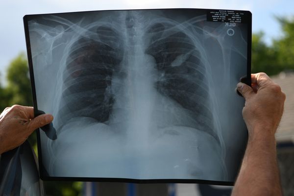 اكتشافُ حول الالتهاب الرئوي قد يحسن علاج الحالات الحادّة