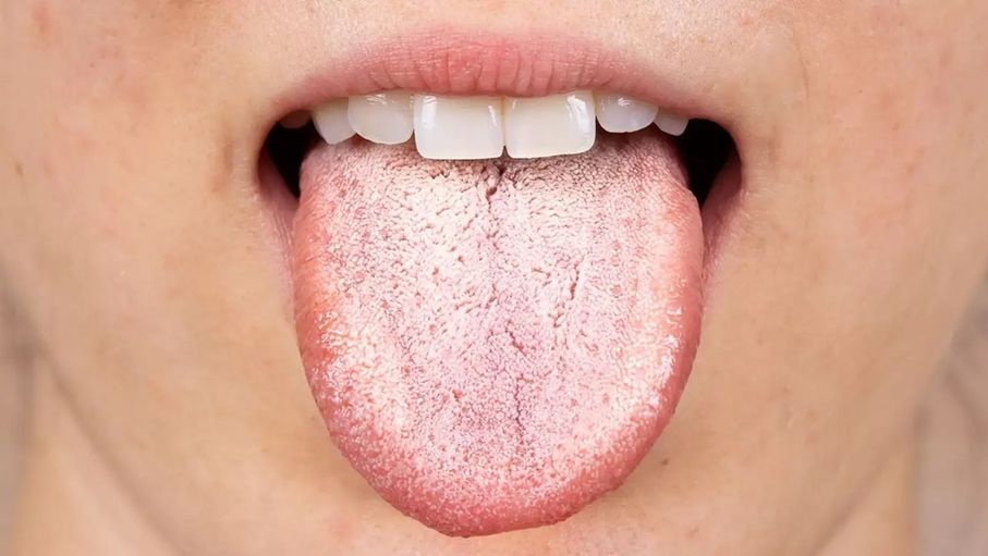 فطريات اللسان.. أعراضها وأسبابها وكيفية علاجها