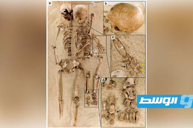 اكتشاف مرض وراثي نادر في هيكل عظمي قديم من العصر الجليدي