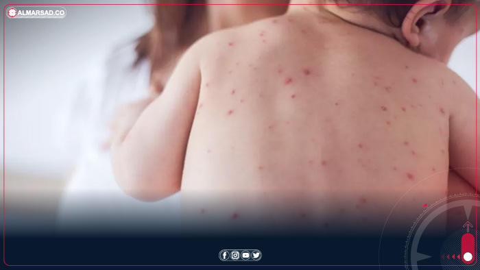 مكافحة الأمراض: حملة التطعيم ضد الحصبة جاءت بعد ارتفاع الإصابات في بعض البلديات